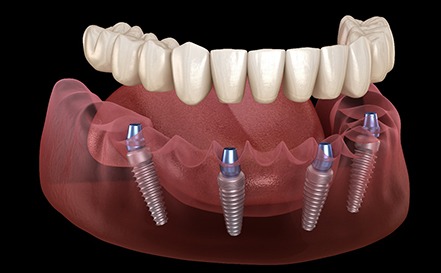 Illustration of All-on-4 in San Antonio, TX for the lower arch