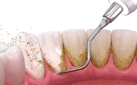 Animated smile during antibiotic therapy treatment