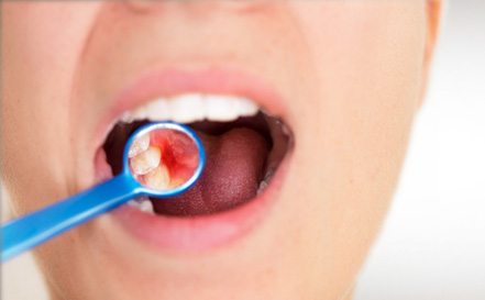 Dental mirror showing gum disease in woman’s mouth