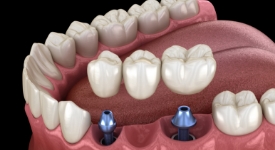 Animated dental implant supported fixed bridge placement