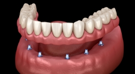 Animated smile during dental implant supported denture placement