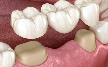 Animated smile during dental bridge placement