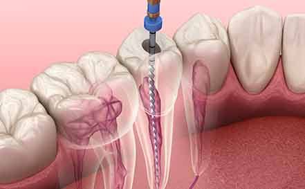 3D render of a root canal