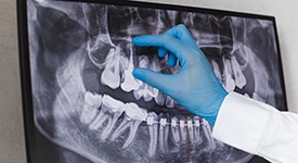 Factors that can affect the cost of a root canal include the location of the infected tooth within the mouth