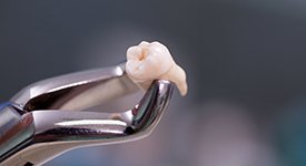 Removing a tooth may be less expensive up front but can be more expensive once replaced
